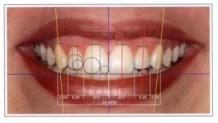 What Does The Dentist Do For Smile Design?