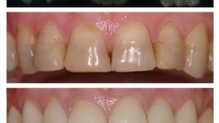 Zirconium Teeth