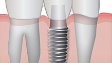 Implants (transplantation dentaire)